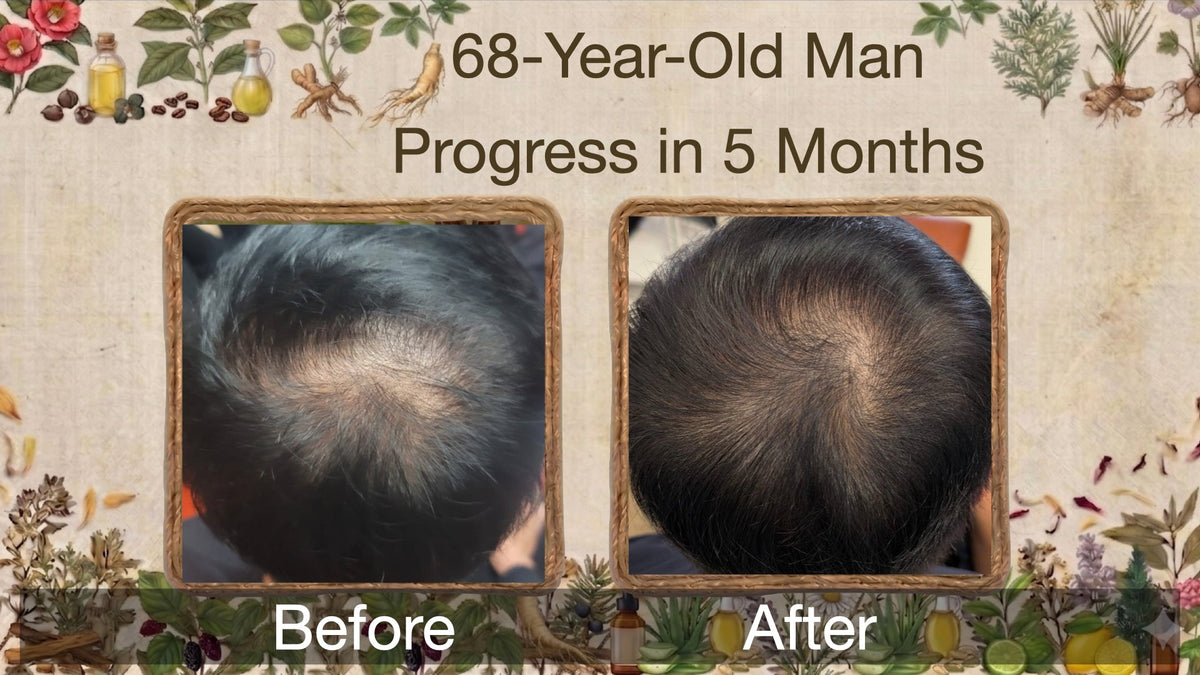 68-Year-Old Man with Androgenetic Alopecia and Senile Hair Loss: New Hair Grew Back Black After 5 Months?