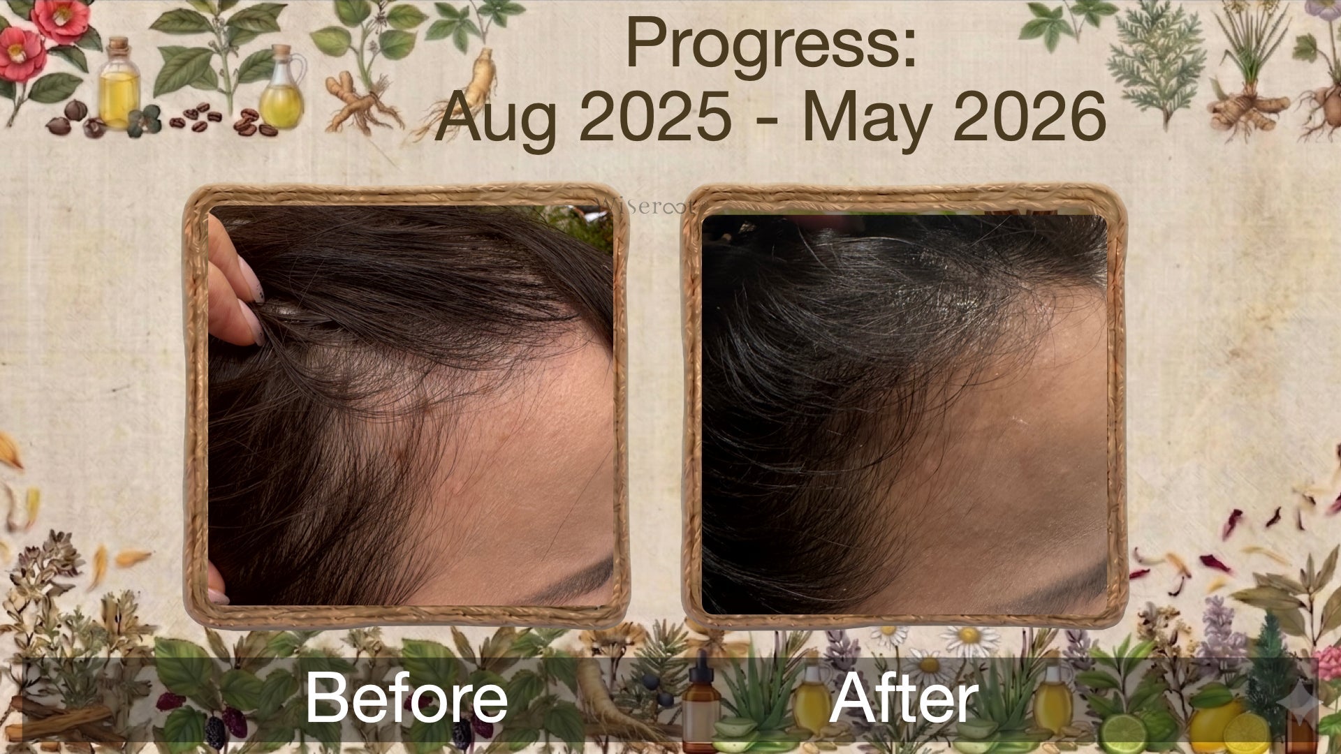 Postpartum Hair Loss & Fine Hair from a High-Stress Job? She Regained Volume in 7 Months | Wiseroot