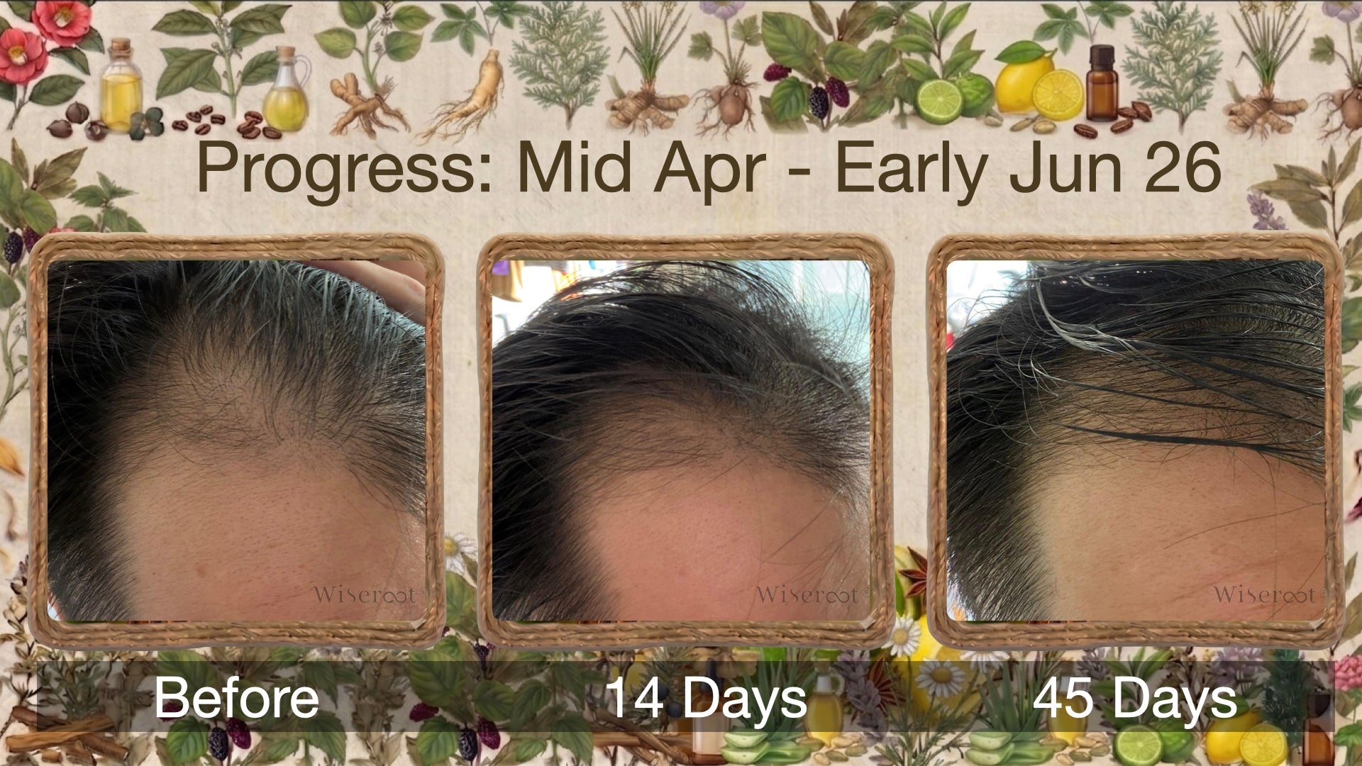 "In Just Over Two Weeks, I Started to Feel Hope Again" — Andy's 45-Day Hair Revival Journey