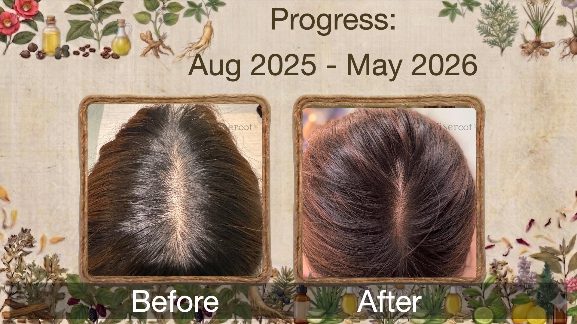 After 9 months of using Wiseroot in May 2026 showing full hair regrowth